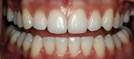 Before and After Invisalign Treatment Kingston Before and After Invisalign Treatment Kingston
