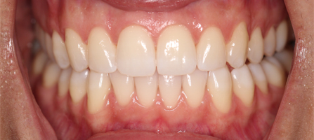 Before and After Invisalign Treatment Kingston Before and After Invisalign Treatment Kingston