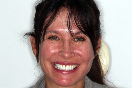Before and After Invisalign Treatment Kingston Before and After Invisalign Treatment Kingston