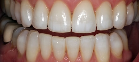 Before and After Invisalign Treatment Kingston Before and After Invisalign Treatment Kingston