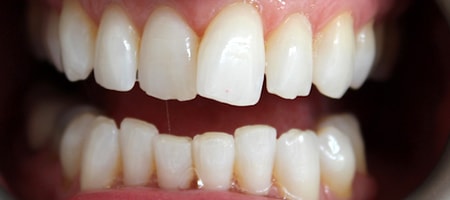 Before and After Invisalign Treatment Kingston Before and After Invisalign Treatment Kingston