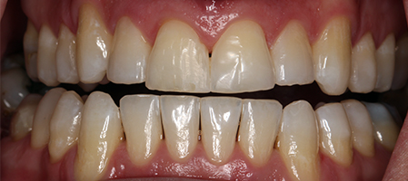 Before and After Invisalign Treatment Kingston Before and After Invisalign Treatment Kingston
