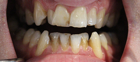 Before and After Invisalign Treatment Kingston Before and After Invisalign Treatment Kingston
