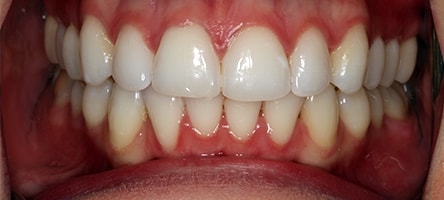 Before and After Invisalign Treatment Kingston Before and After Invisalign Treatment Kingston
