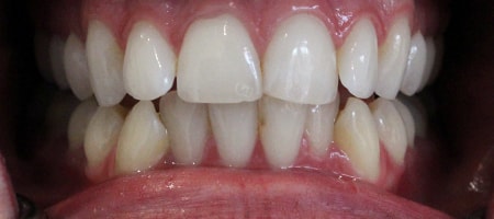 Before and After Invisalign Treatment Kingston Before and After Invisalign Treatment Kingston