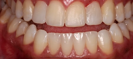 Before and After Invisalign Treatment Kingston Before and After Invisalign Treatment Kingston