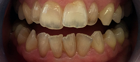 Before and After Invisalign Treatment Kingston Before and After Invisalign Treatment Kingston