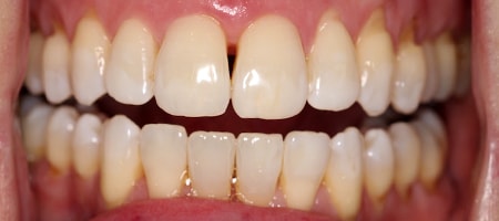 Before and After Invisalign Treatment Kingston Before and After Invisalign Treatment Kingston
