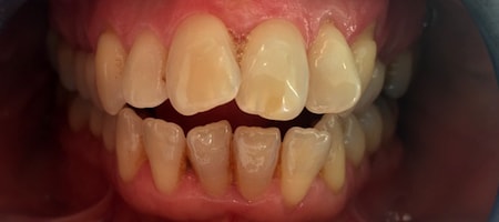 Before and After Invisalign Treatment Kingston Before and After Invisalign Treatment Kingston