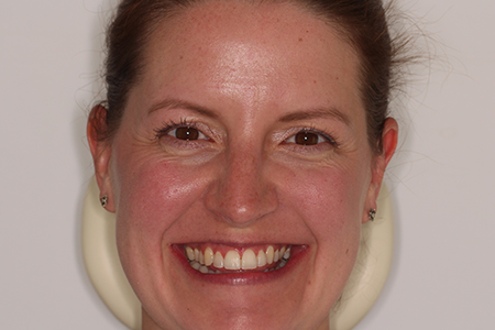 Before and After Invisalign Treatment Kingston Before and After Invisalign Treatment Kingston