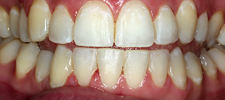 Before and After Invisalign Treatment Kingston Before and After Invisalign Treatment Kingston