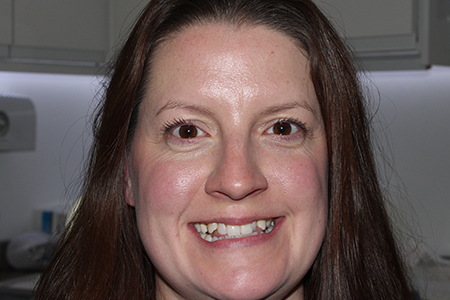 Before and After Invisalign Treatment Kingston Before and After Invisalign Treatment Kingston