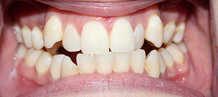 Before and After Invisalign Treatment Kingston Before and After Invisalign Treatment Kingston