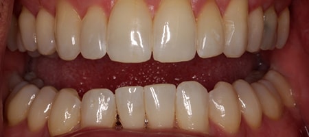 Before and After Invisalign Treatment Kingston Before and After Invisalign Treatment Kingston