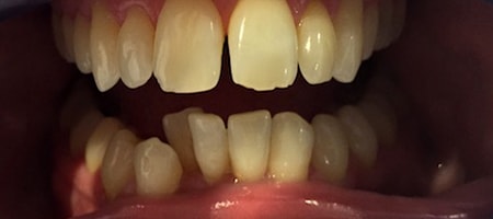 Before and After Invisalign Treatment Kingston Before and After Invisalign Treatment Kingston