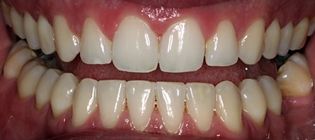 Before and After Invisalign Treatment Kingston Before and After Invisalign Treatment Kingston
