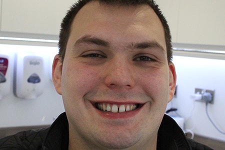 Before and After Invisalign Treatment Kingston Before and After Invisalign Treatment Kingston