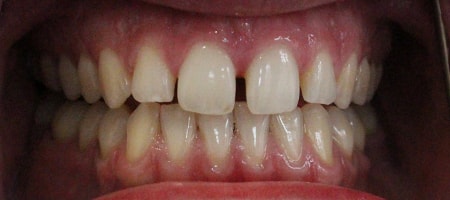 Before and After Invisalign Treatment Kingston Before and After Invisalign Treatment Kingston