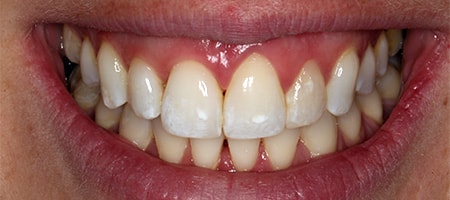Before and After Invisalign Treatment Kingston Before and After Invisalign Treatment Kingston
