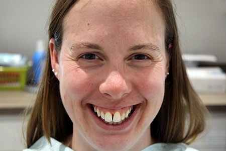 Before and After Invisalign Treatment Kingston Before and After Invisalign Treatment Kingston