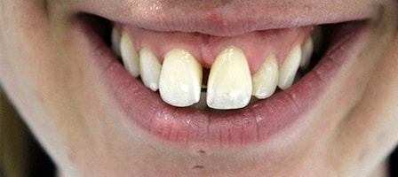 Before and After Invisalign Treatment Kingston Before and After Invisalign Treatment Kingston