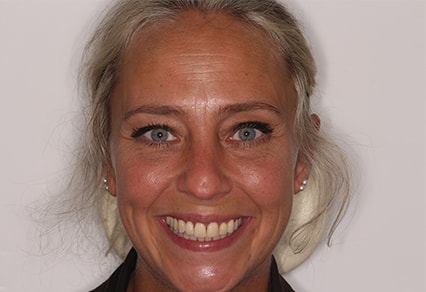 Before and After Invisalign Treatment Kingston Before and After Invisalign Treatment Kingston