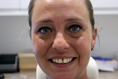 Before and After Invisalign Treatment Kingston Before and After Invisalign Treatment Kingston