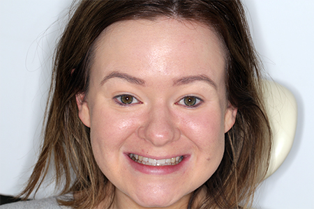 Before and After Invisalign Treatment Kingston Before and After Invisalign Treatment Kingston