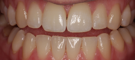 Before and After Invisalign Treatment Kingston Before and After Invisalign Treatment Kingston
