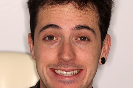 Before and After Invisalign Treatment Kingston