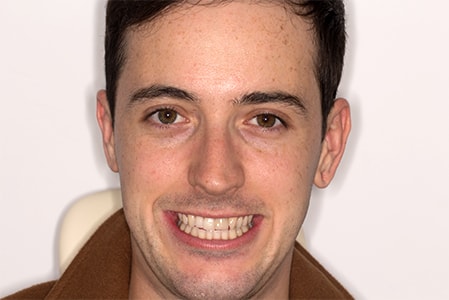 Before and After Invisalign Treatment Kingston