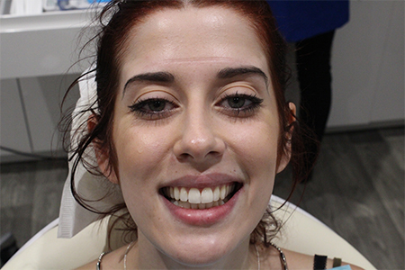 Before and After Invisalign Treatment Kingston