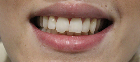 Before and After Invisalign Treatment Kingston