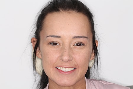 Before and After Invisalign Treatment Kingston Before and After Invisalign Treatment Kingston