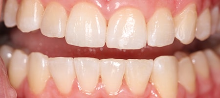 Before and After Invisalign Treatment Kingston Before and After Invisalign Treatment Kingston