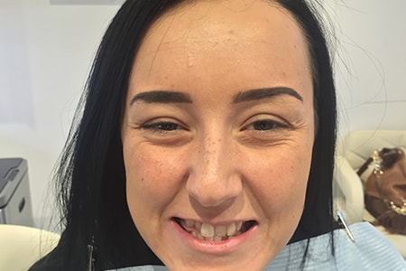 Before and After Invisalign Treatment Kingston Before and After Invisalign Treatment Kingston