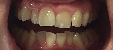 Before and After Invisalign Treatment Kingston Before and After Invisalign Treatment Kingston