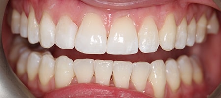 Before and After Invisalign Treatment Kingston Before and After Invisalign Treatment Kingston