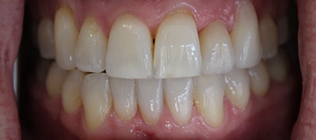 Before and After Invisalign Treatment Kingston Before and After Invisalign Treatment Kingston