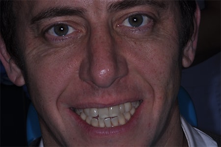 Before and After Invisalign Treatment Kingston Before and After Invisalign Treatment Kingston