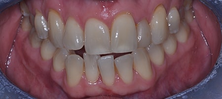 Before and After Invisalign Treatment Kingston Before and After Invisalign Treatment Kingston