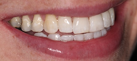 Before and After Invisalign Treatment Kingston Before and After Invisalign Treatment Kingston
