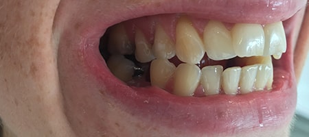 Before and After Invisalign Treatment Kingston Before and After Invisalign Treatment Kingston