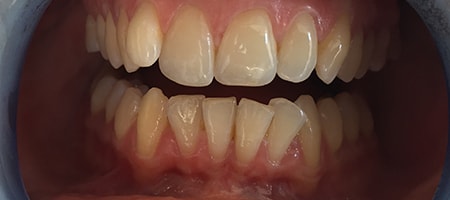 Before and After Invisalign Treatment Kingston Before and After Invisalign Treatment Kingston