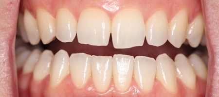 Before Invisalign Treatment Reading Smiles