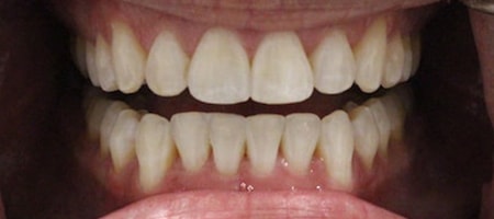 Before and After Invisalign Treatment Kingston Before and After Invisalign Treatment Kingston