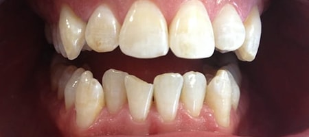 Before and After Invisalign Treatment Kingston Before and After Invisalign Treatment Kingston