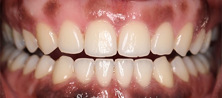 Before and After Invisalign Treatment Kingston Before and After Invisalign Treatment Kingston
