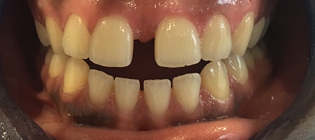 Before and After Invisalign Treatment Kingston Before and After Invisalign Treatment Kingston
