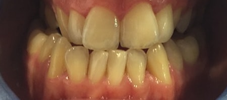 Before and After Invisalign Treatment Kingston Before and After Invisalign Treatment Kingston